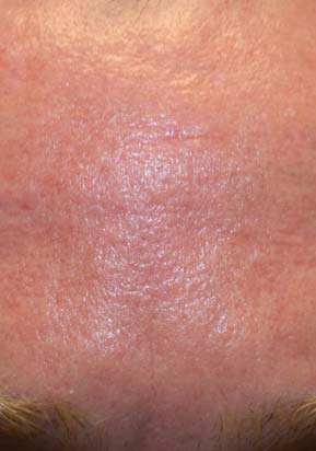 אחרי טיפול למיצוק העור באמצעות מכשיר Palomar Lux1540 