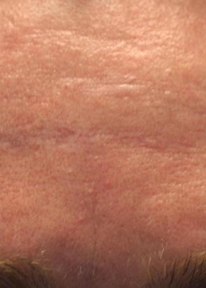 לפני טיפול למיצוק העור באמצעות מכשיר Palomar Lux1540