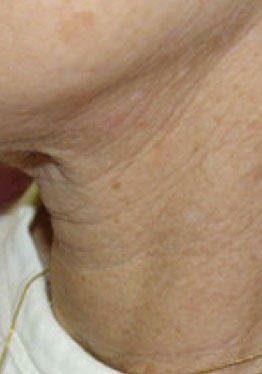 לפני טיפול למיצוק העור באמצעות מכשיר Palomar Lux1540
