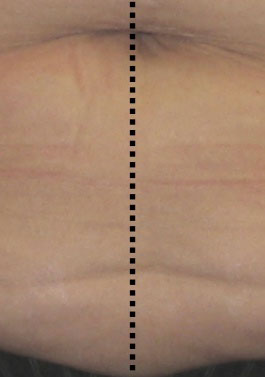 אחרי טיפול למיצוק העור באמצעות מכשיר Palomar LuxIR