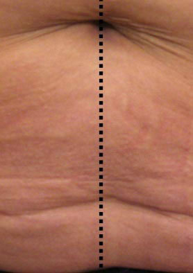 לפני טיפול למיצוק העור באמצעות מכשיר Palomar LuxIR