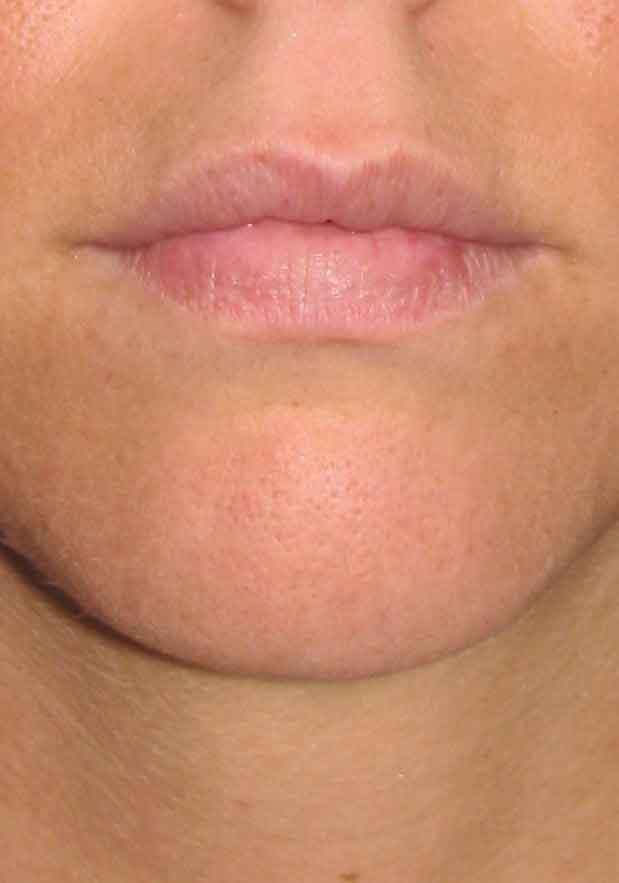 לאחר ניתוח לתיקון עיבוי שפתיים לא מוצלח בסיליקון