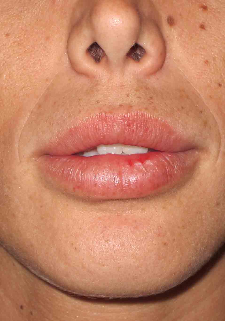 לאחר תיקון לעיבוי שפתיים