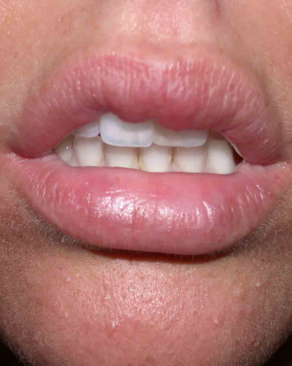 לפני ניתוח לתיקון עיבוי שפתיים לא מוצלח בסיליקון