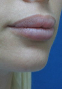 לפני תיקון עיבוי שפתיים