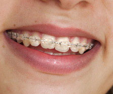 יישור שיניים לילדים, יישור שיניים, יישור שינים, יישור שיניים שקוף, גשר לשיניים, ישור שיניים
