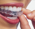 invisalign - אינויזליין יישור שיניים שקוף